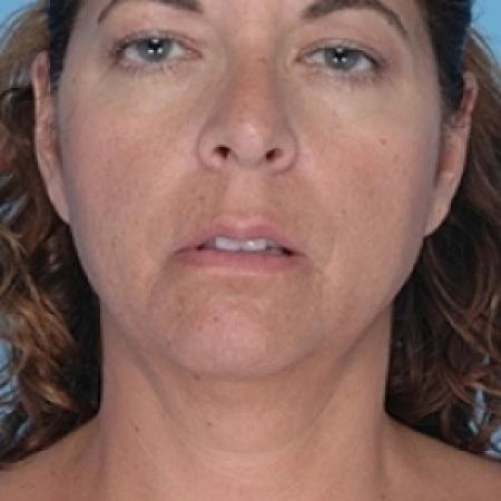 Before image 1 Case #79231 - Liposuction