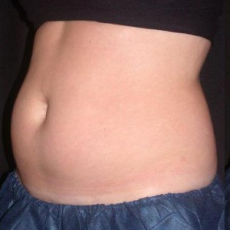 Before image 1 Case #81856 - CoolSculpting
