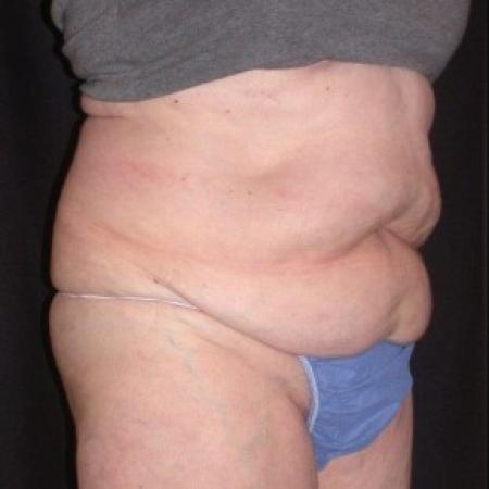 Before image 5 Case #81861 - CoolSculpting