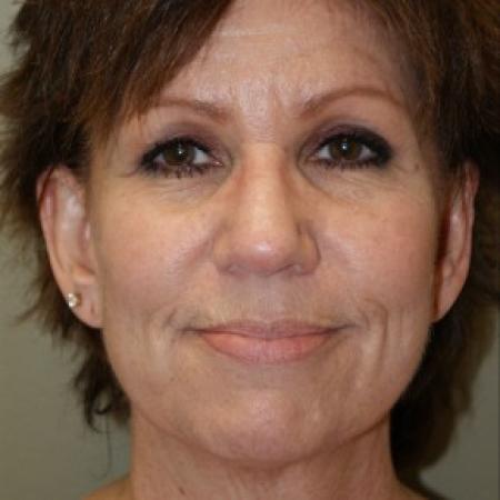 Before image 1 Case #81901 - Facelift 
