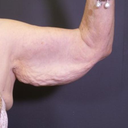 Before image 1 Case #84176 - Arm Lift
