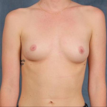 Before image 1 Case #82546 - dual-plane subpectoral breast augmentation with silicone gel breast implants