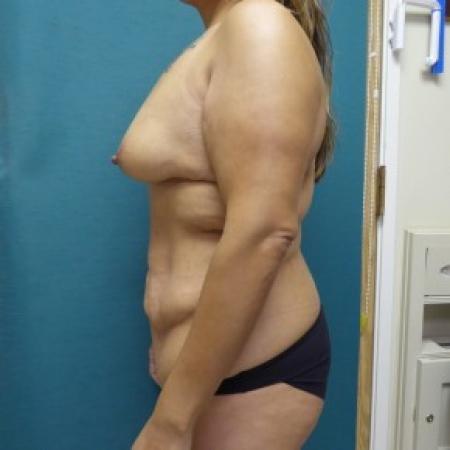 Before image 2 Case #86841 - Standard Abdominoplasty after massive weight loss