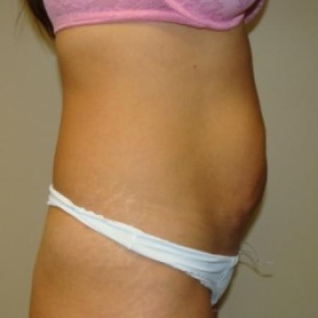 Before image 4 Case #80116 - Abdominoplasty