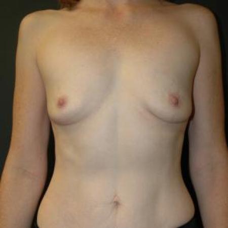 Before image 1 Case #80876 - Breast Augmentation