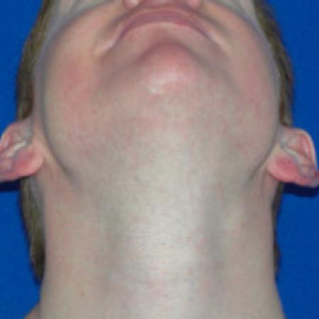 Before image 3 Case #88341 - Otoplasty