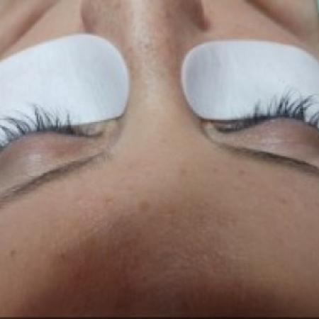 Before Case #86386 - 38 year old woman treated with eyelash enhancement