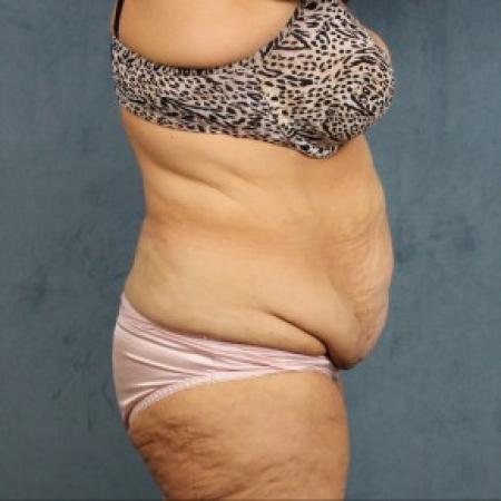 Before image 3 Case #82551 - extended abdominoplasty (tummy tuck) after massive weight loss