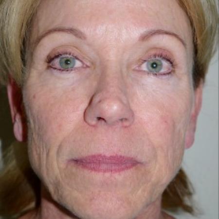 Before image 1 Case #82441 - 56 year old with facial wrinkles, history of acne scarring