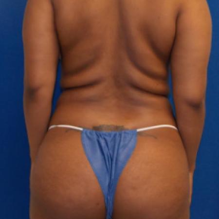 Before Case #88321 - Brazilian Buttock Lift 