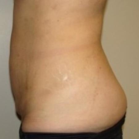 Before image 3 Case #79481 - Tummy Tuck