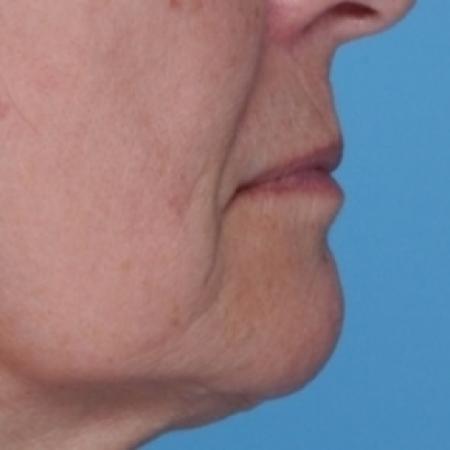 Before Case #80576 - Lip Augmentation