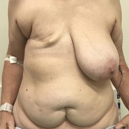 Before image 1 Case #87631 - DIEP Flap Breast Reconstrution