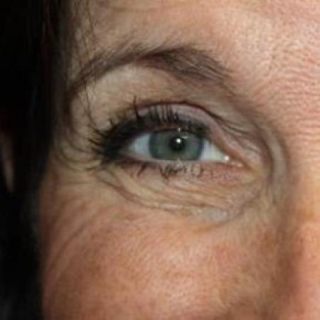 Before image 3 Case #85301 - Botox (Glabella & Crows Feet) - 54 year old female.