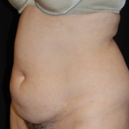 Before image 2 Case #79766 - Tummy Tuck & Lipo of Love Handles