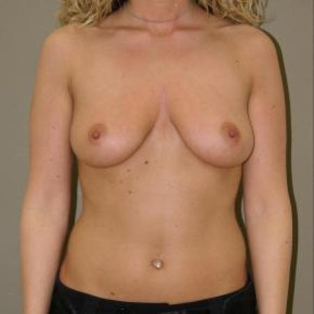 Before image 1 Case #80921 - Breast Augmentation