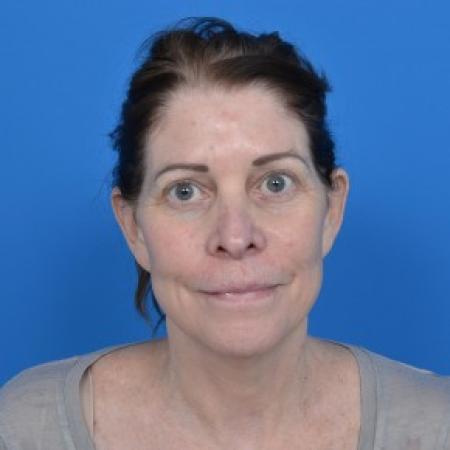 Before image 1 Case #87926 - Facelift and Necklift