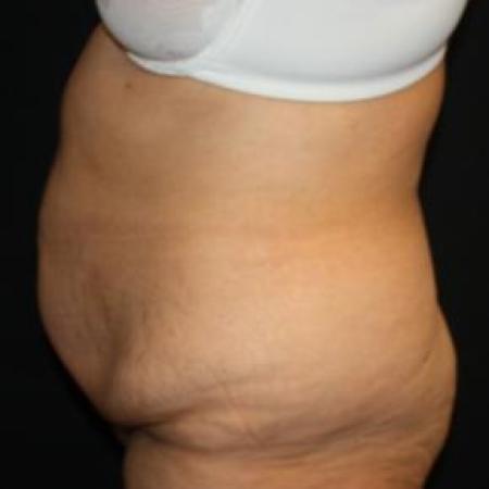 Before image 3 Case #85866 - Total Body Lift - 57 year old female