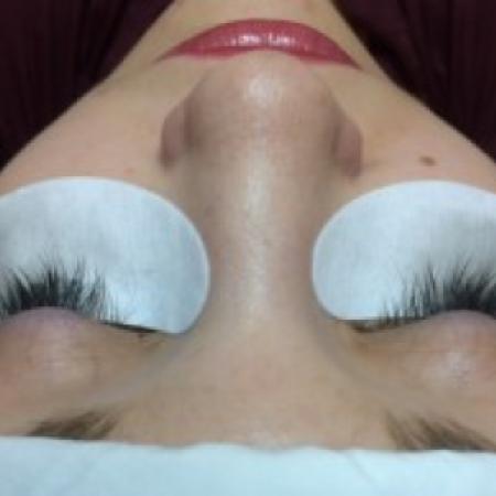 Before Case #86396 - 26 year old woman treated with eyelash enhancement