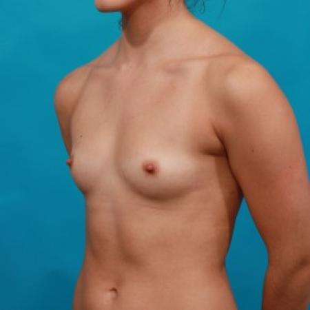 Before image 2 Case #85726 - Sientra Breast Implants
