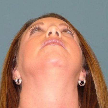 Before image 4 Case #86736 - Rhinoplasty+ chin augmentation with silicone implant