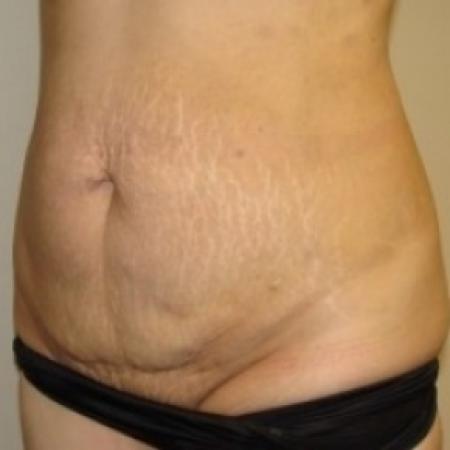 Before image 2 Case #79481 - Tummy Tuck