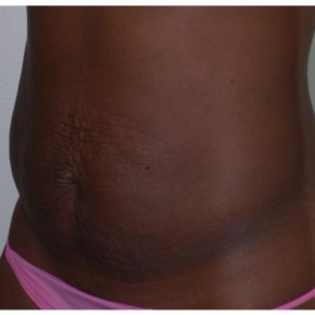 Before image 2 Case #86971 - Tummy Tuck