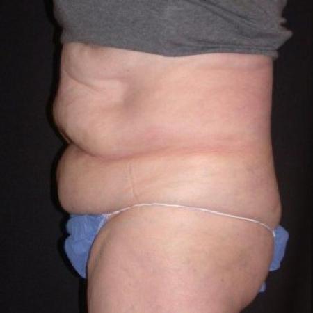 Before image 4 Case #81861 - CoolSculpting