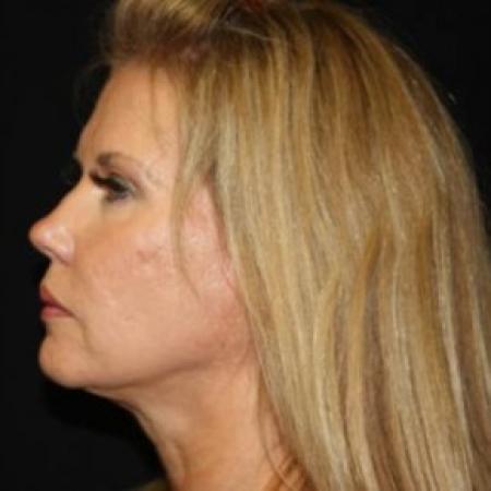 Before image 3 Case #85286 - Facelift and Neck Lift - 54 year old female