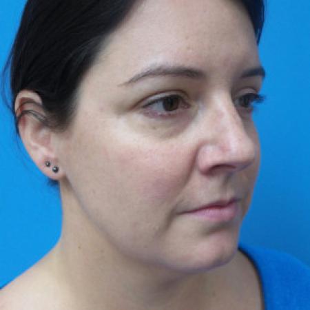 Before image 2 Case #88206 - 40 year old  -  Rhinoplasty & Septoplasty  -  1 month post-op