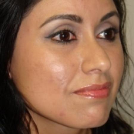 Before image 4 Case #79041 - Rhinoplasty
