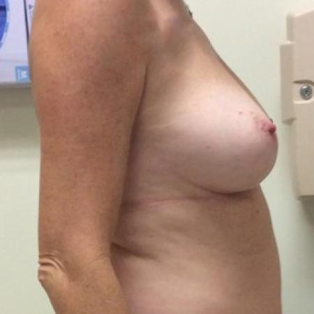 Before image 3 Case #87286 - Implant Based Breast Reconstruction