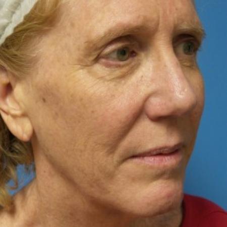 Before image 2 Case #86746 - Facelift/Browlift/Laser Resurfacing to Full Face - 2 months post-op