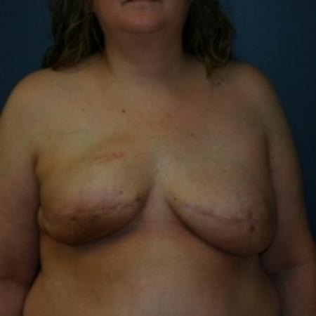 Before image 1 Case #81251 - Breast reconstruction with implants after mastectomy