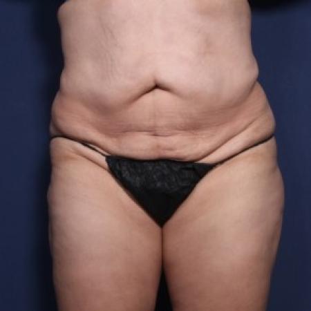 Before image 1 Case #83571 - 36 Years Old Female 