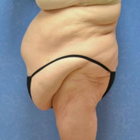 Before image 1 Case #81406 - Circumferential body lift with abdominal wall plication