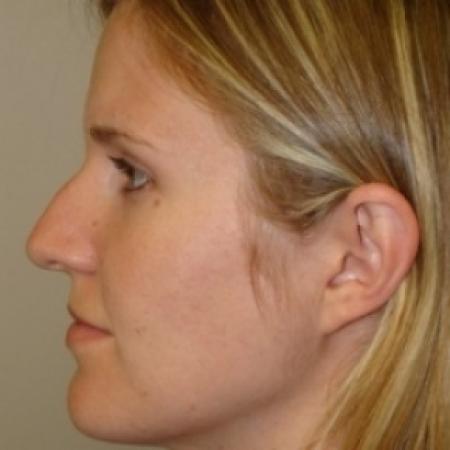 Before image 5 Case #79551 - Rhinoplasty