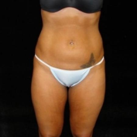 Before image 1 Case #80481 - Buttocks Augmentation Via Fat Grafting with Lipsuction of Abdomen, Waist, Flanks, and Outer Thighs