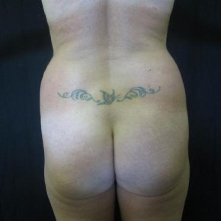 Before Case #82641 - Fat transfer to Buttocks