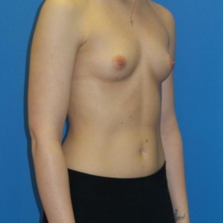 Before image 2 Case #84551 - Breast Augmentation