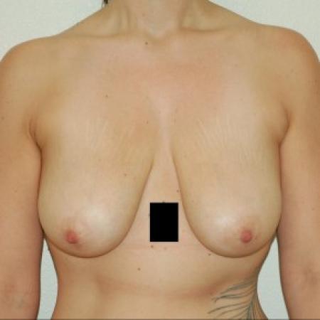 Before image 1 Case #84631 - Breast Lift