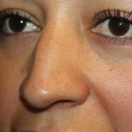 Before image 2 Case #85136 - Rhinoplasty - 43 year old female