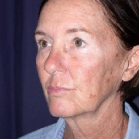 Before image 2 Case #78811 - FaceLift- Minimal Access Cranial Suspension (MACS)/ Fat Grafting 