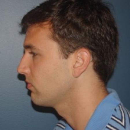 Before image 3 Case #81261 - Rhinoplasty