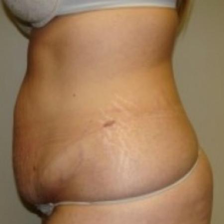 Before image 3 Case #79471 - Tummy Tuck