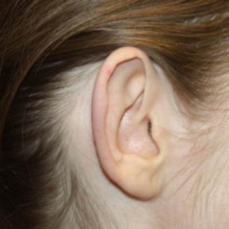 Before image 3 Case #84636 - Otoplasty - 17 year old female