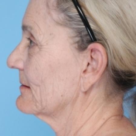 Before image 2 Case #79691 - Facelift 