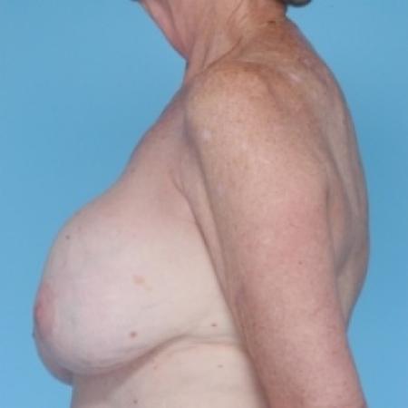 Before image 3 Case #79666 - Breast Augmentation 