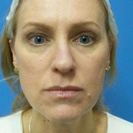 Before image 1 Case #87096 - 49 year old  -  Rhinoplasty/Septoplasty/Turbinectomy  -  3 months post-op
