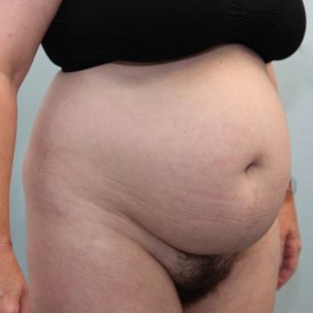 Before image 4 Case #86546 - BAND Abdominoplasty